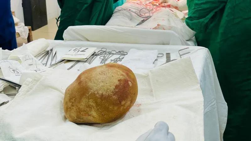 Doctors remove 3.1kg stone from man's bladder and claim record
